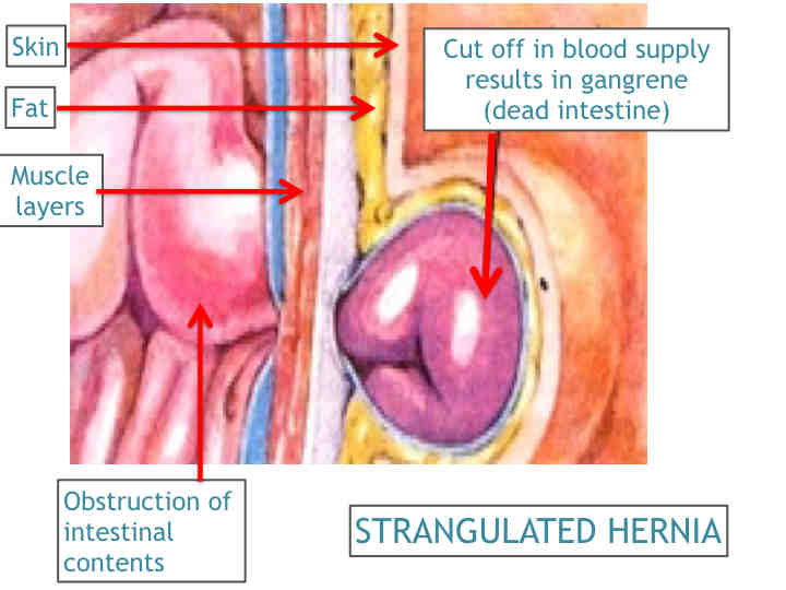 Inguinal Hernia Doctor Clinic Surgery Mumbai Laparoscopic Hernia